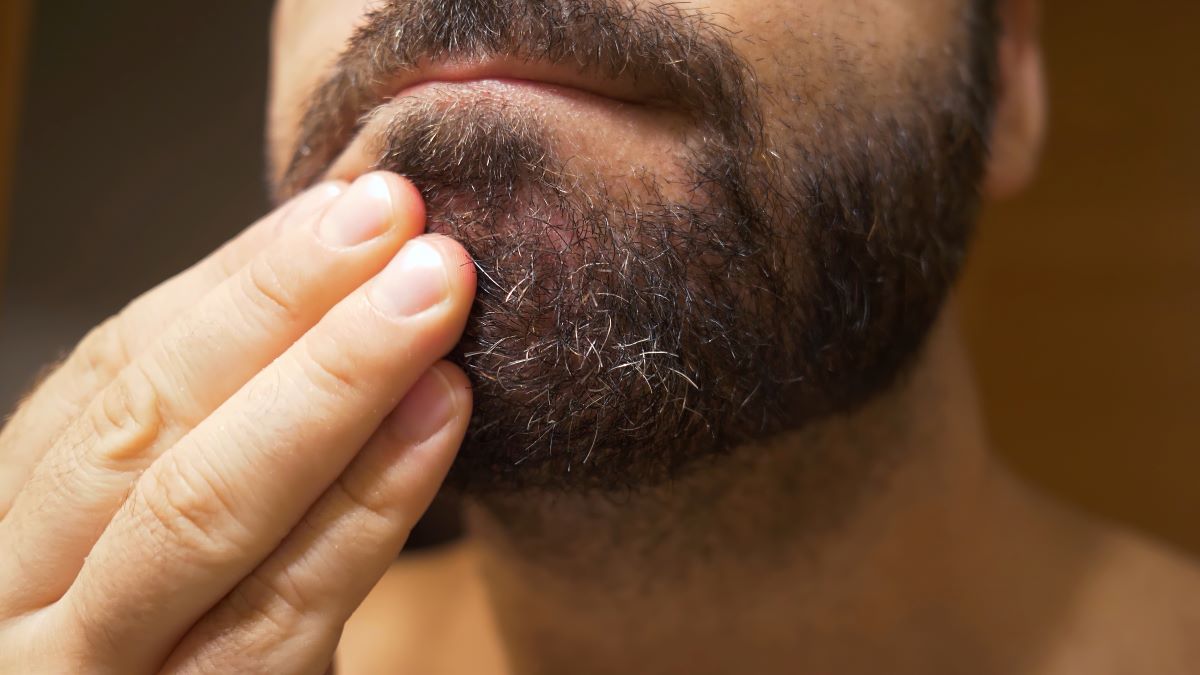Mann mit Schuppen im Bart