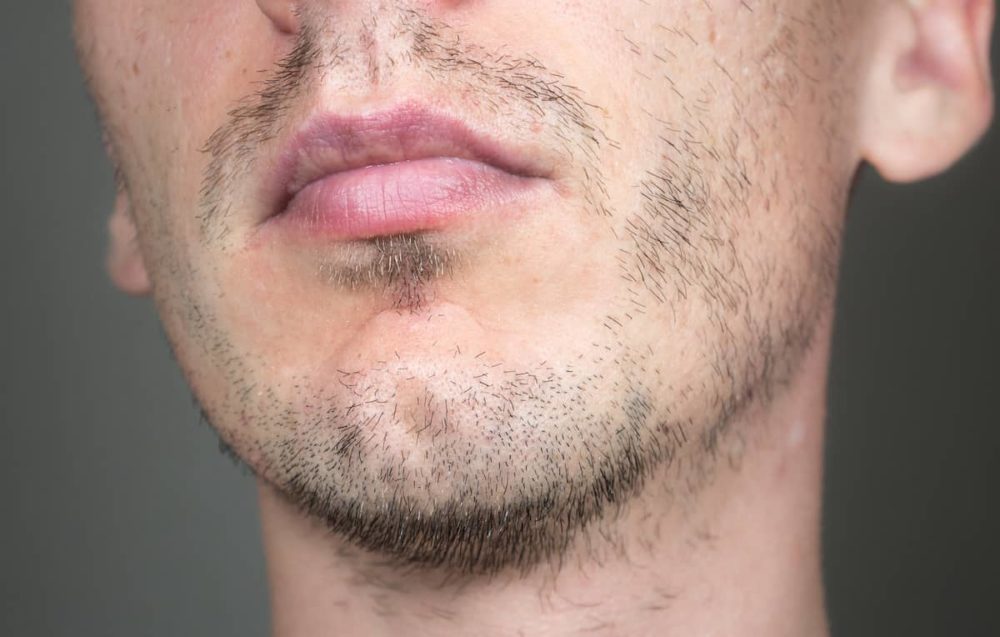 Bartverdichtung gegen kahle Stellen Heisenbeard
