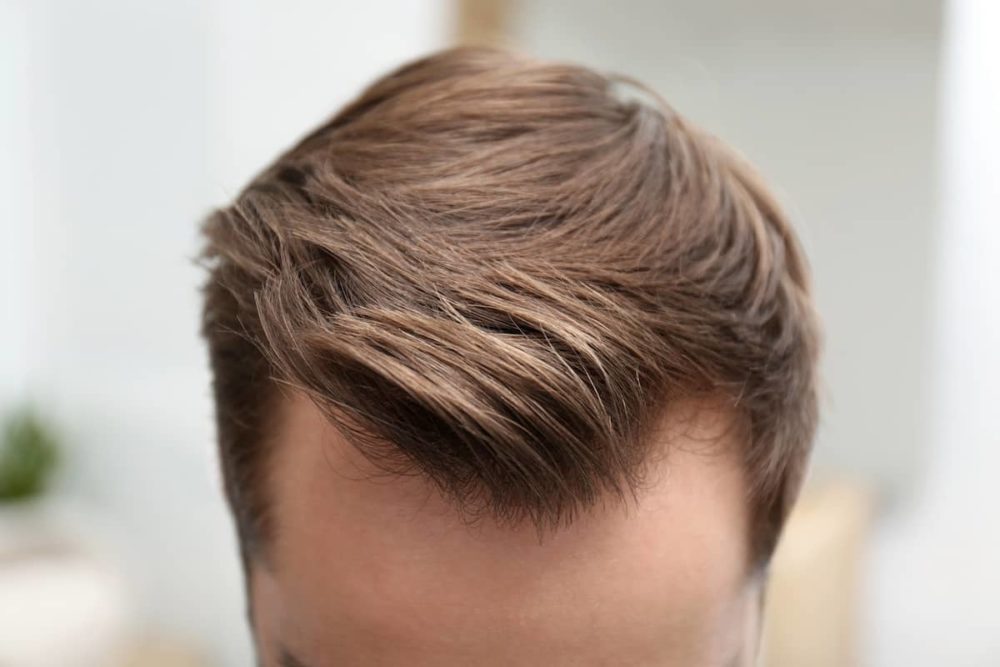 Frisuren bei Geheimratsecken für Männer