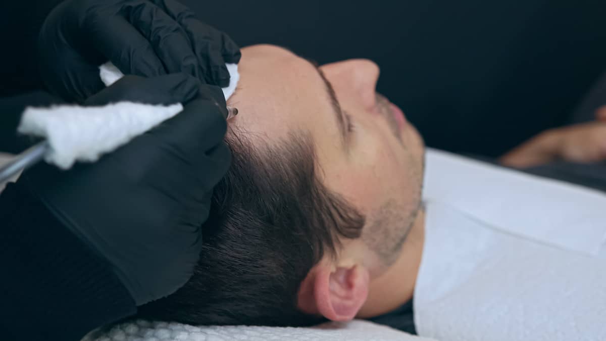 Mann unterzieht sich einer Haarpigmentierung in Ergänzung zur haartransplantation