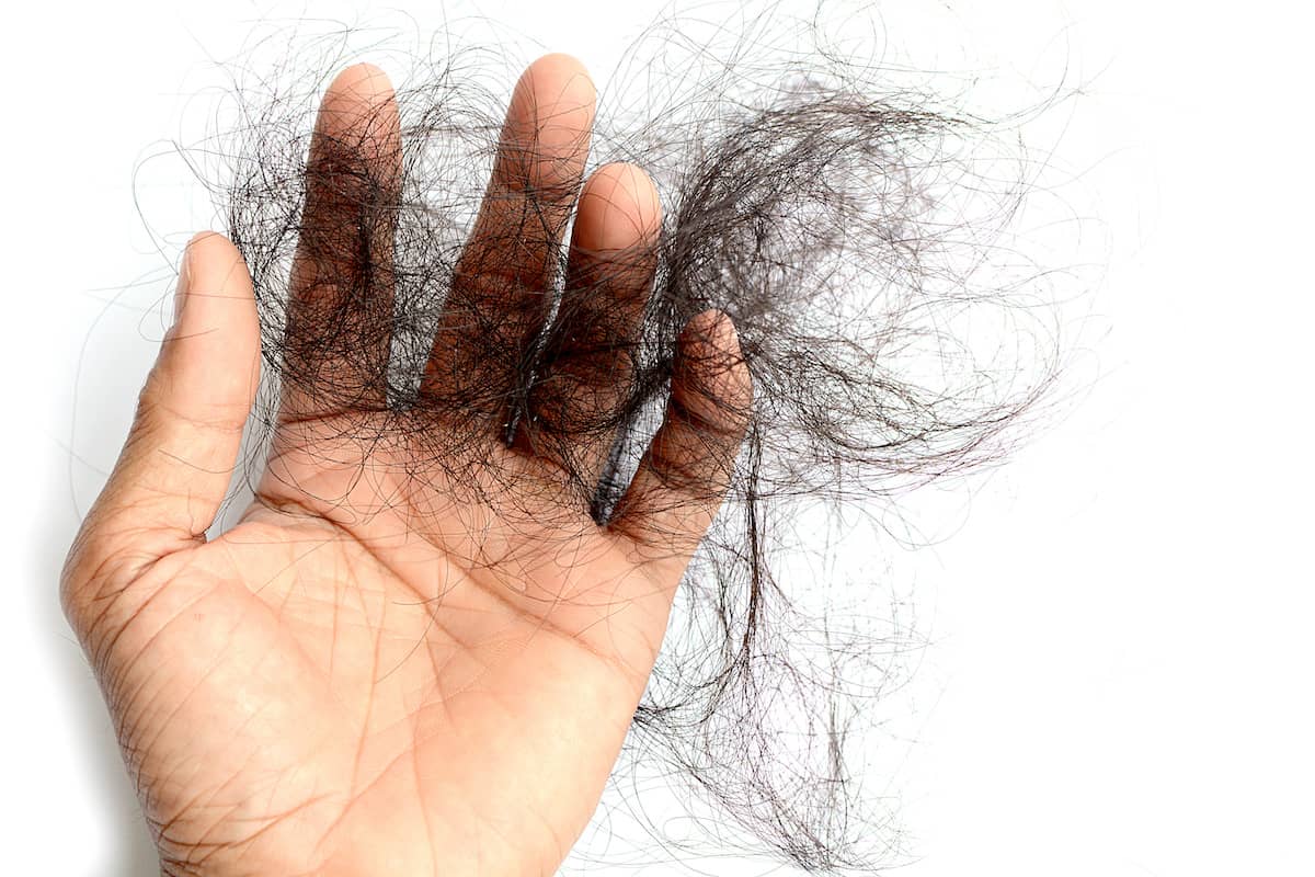 Mann hält seine ausgefallenen Haare nach Haartransplantation in der Hand
