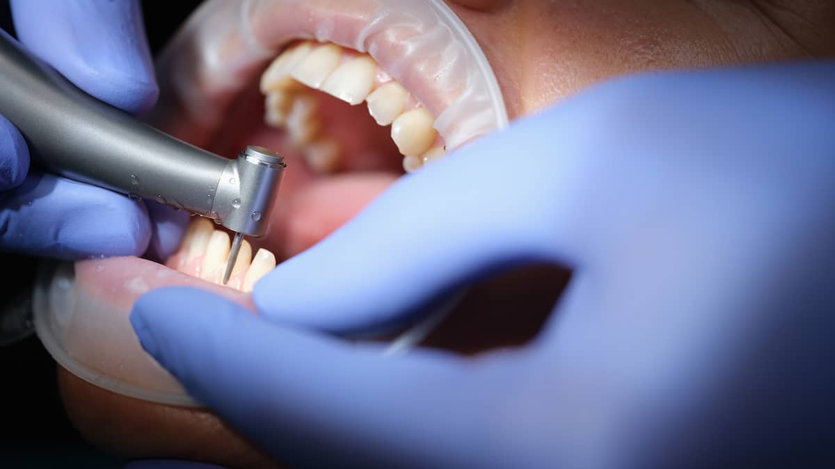Zähne eines Patienten werden in Vorbereitung auf Veneers abgeschliffen
