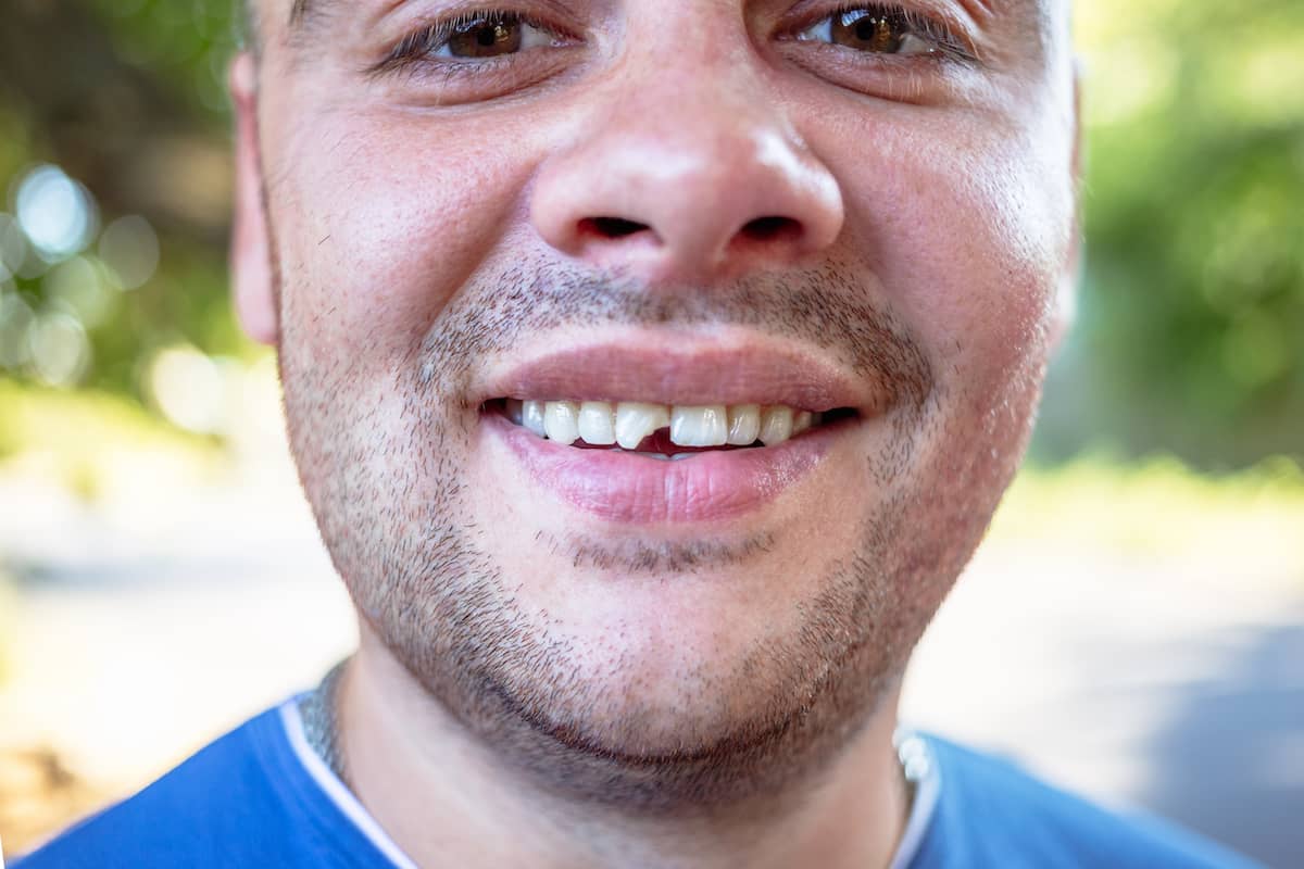 Nahaufnahme von Mann mit Zahnfraktur