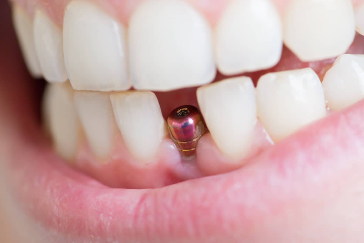 Nahaufnahme von einem Zahnimplantat im Unterkiefer eines Patienten