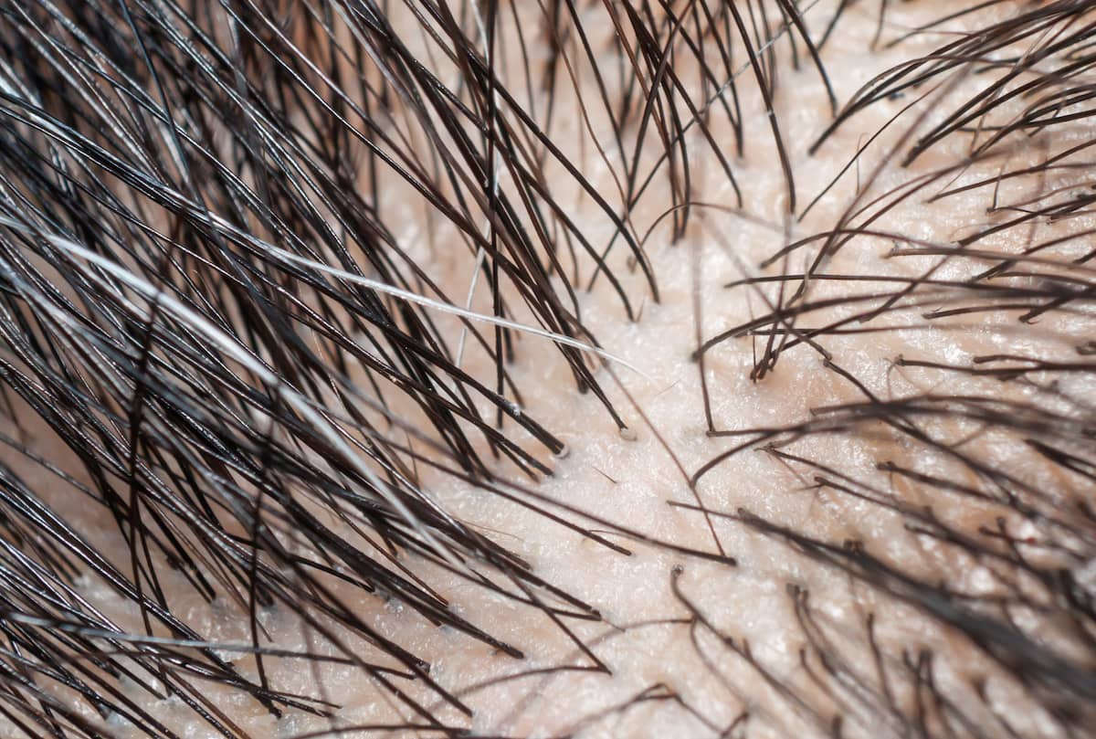 Trichoskopie-Nahaufnahme der Kopfhaut eines Patienten, der unter diffusem Haarausfall leidet