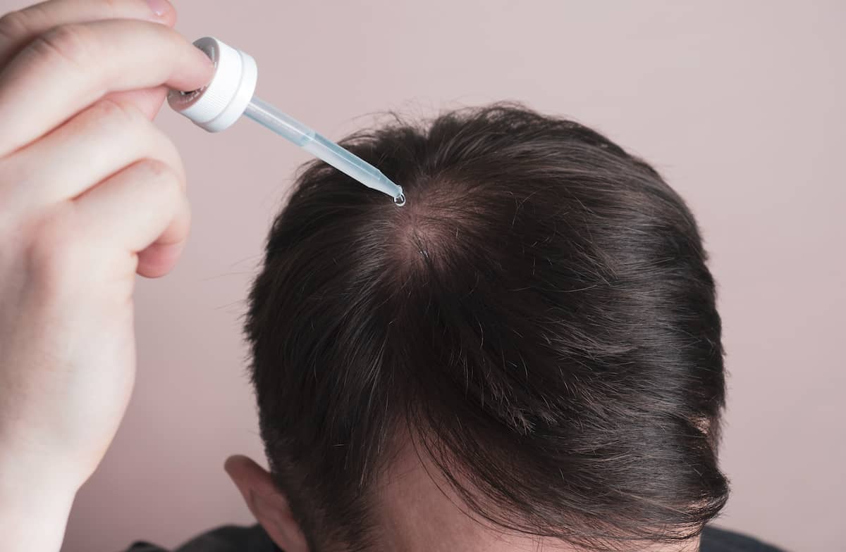 Mann gibt Minoxidillösung mit Pipette auf Kopfhaut, um erblich bedingten Haarausfall zu behandeln