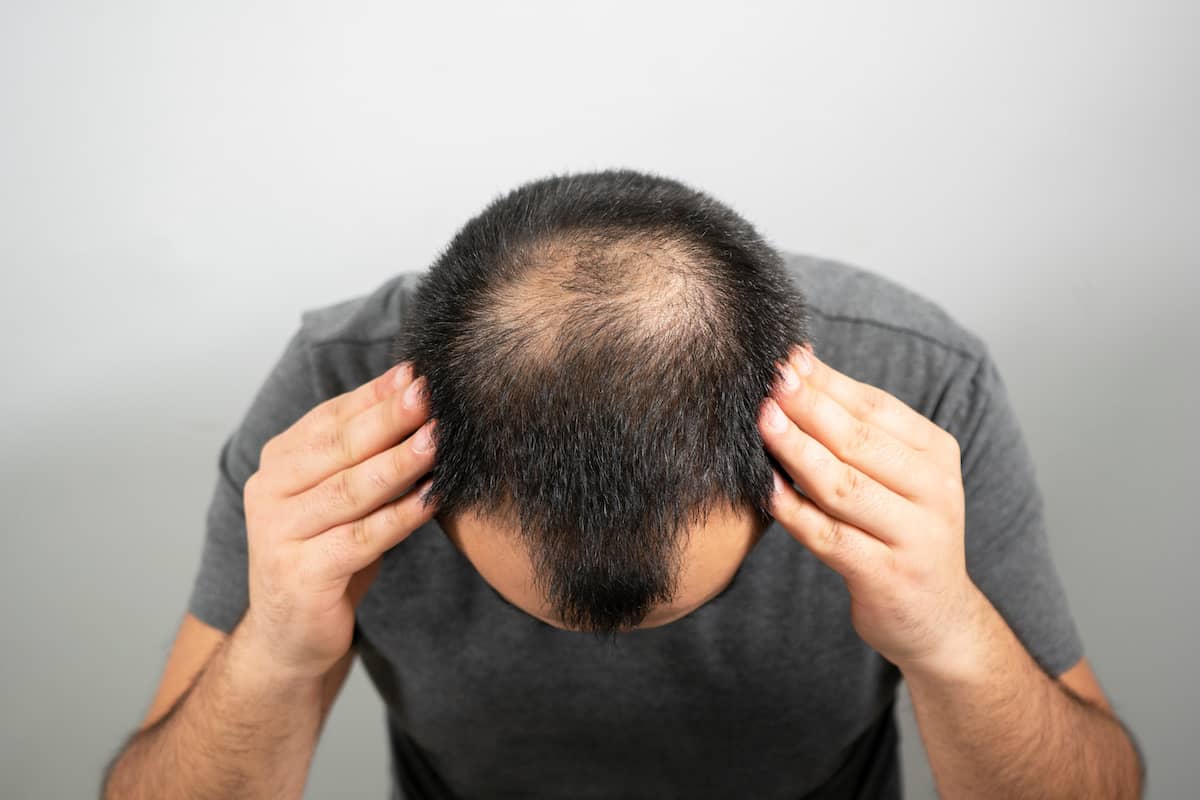 Blick auf den Kopf eines Mannes mit erblich bedingtem Haarausfall.