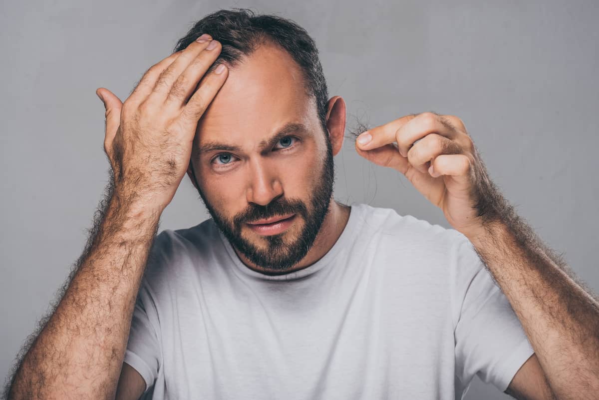 Erblich bedingter Haarausfall: Mann mit Geheimratsecken hält ausgefallene Haare in die Kamera