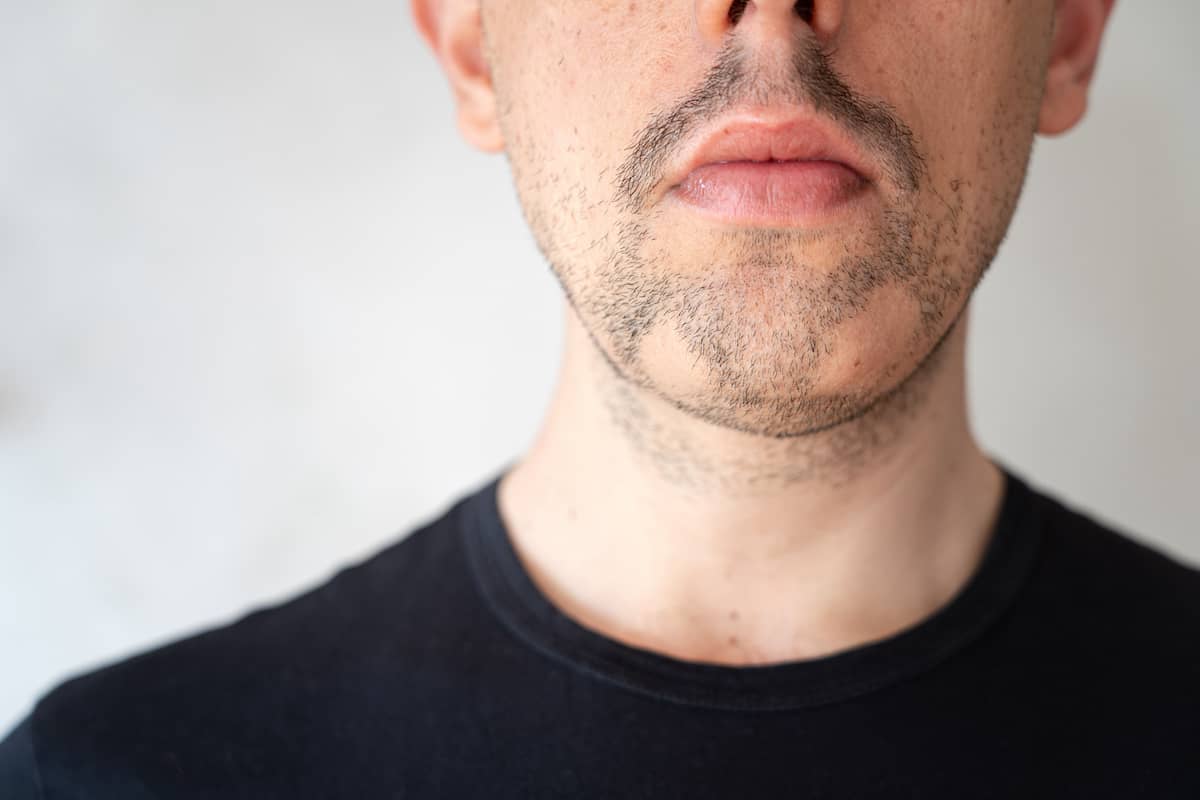Kreisrunder Haarausfall im Bartbereich eines Mannes