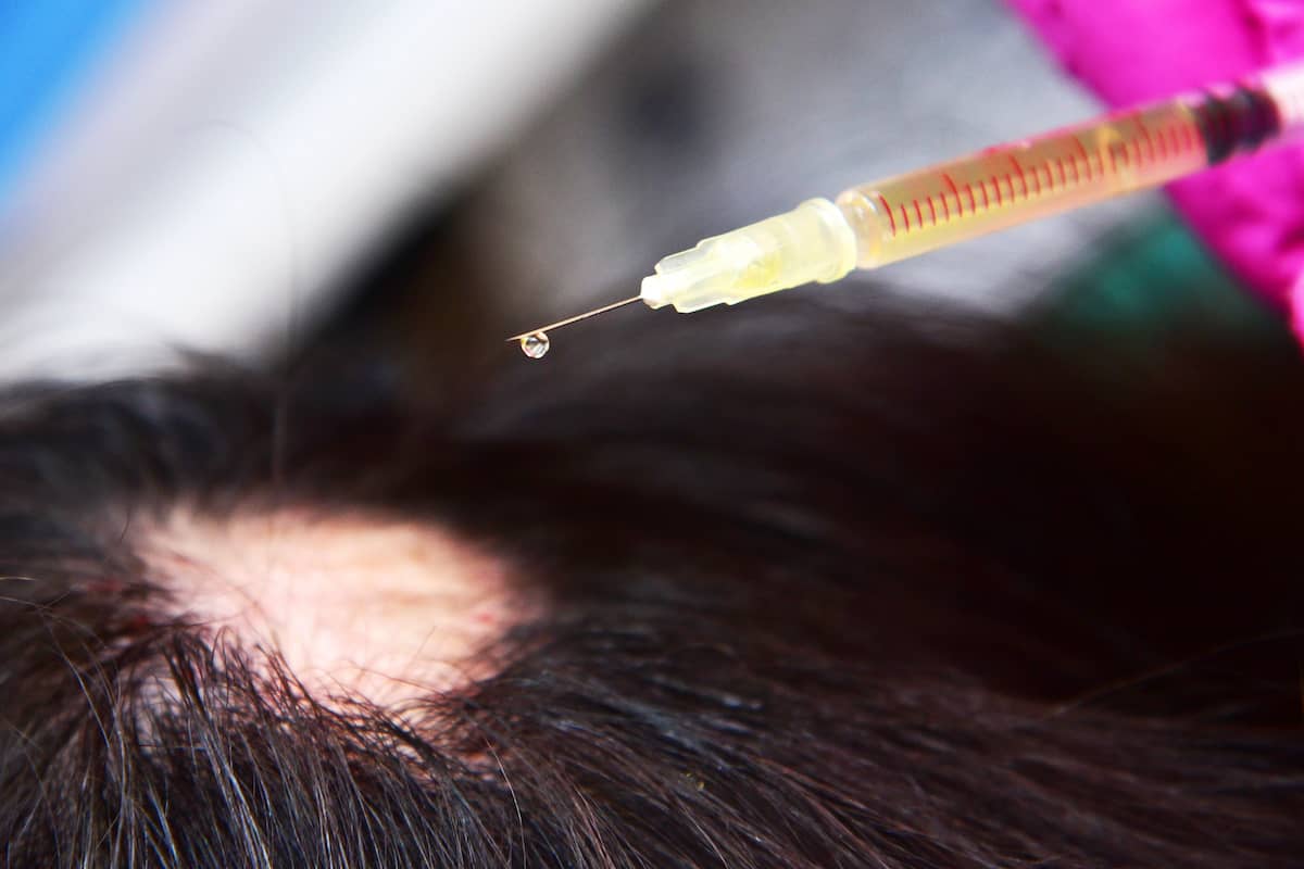 Patient mit kreisrundem Haarausfall erhält eine Corticosteroid-Injektion in die betroffene Stelle
