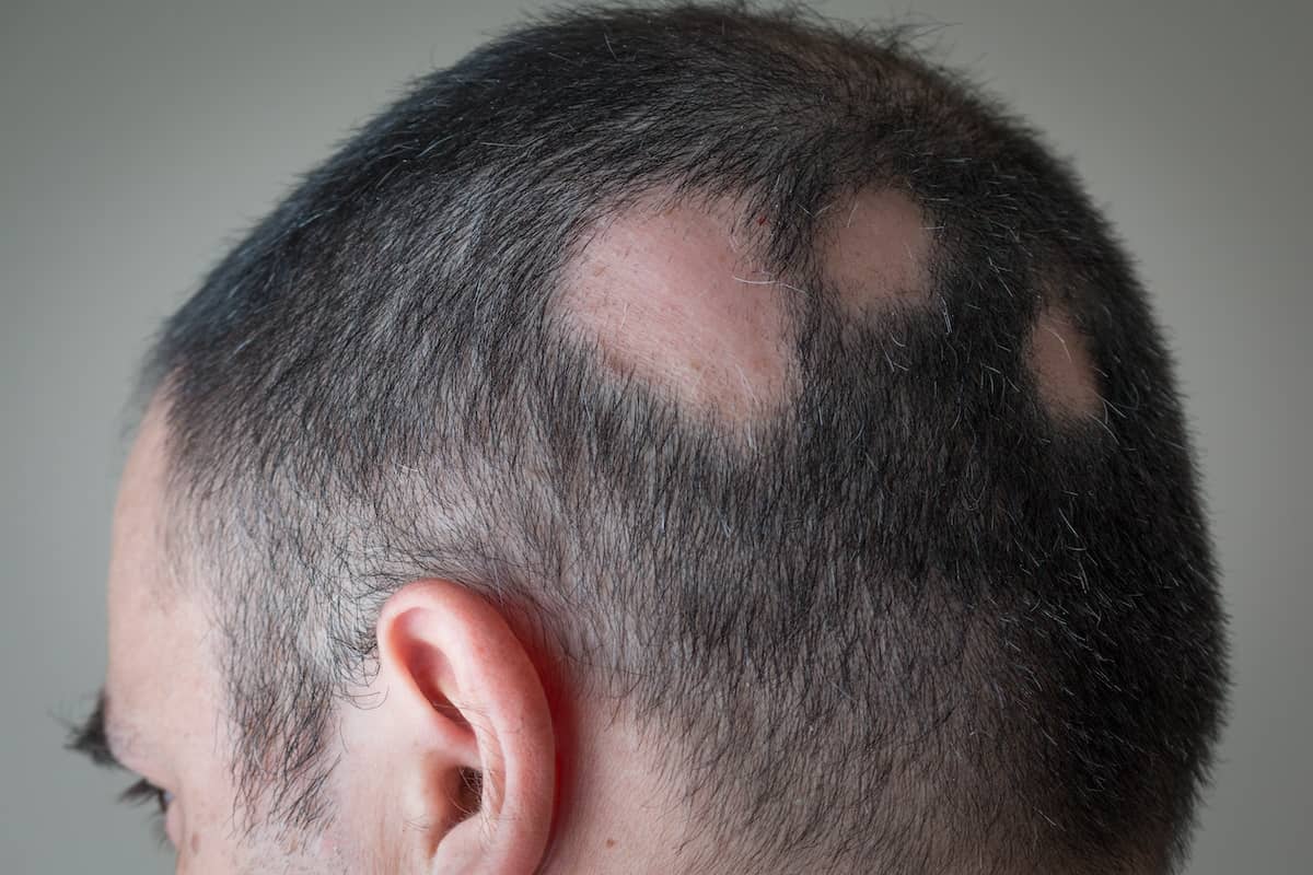 Kreisrunder Haarausfall auf dem Kopf eines Mannes