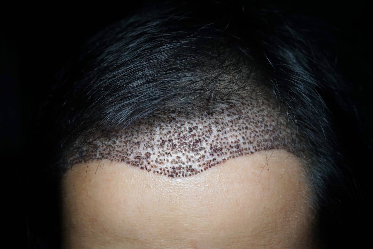 Mann zeigt sein Ergebnis direkt nach der Haartransplantation 