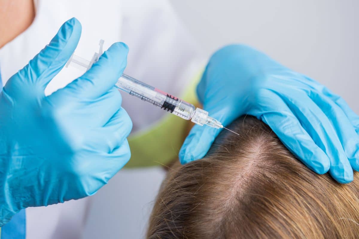 Mesotherapie wird bei einer Frau mit Haarausfall angewendet 