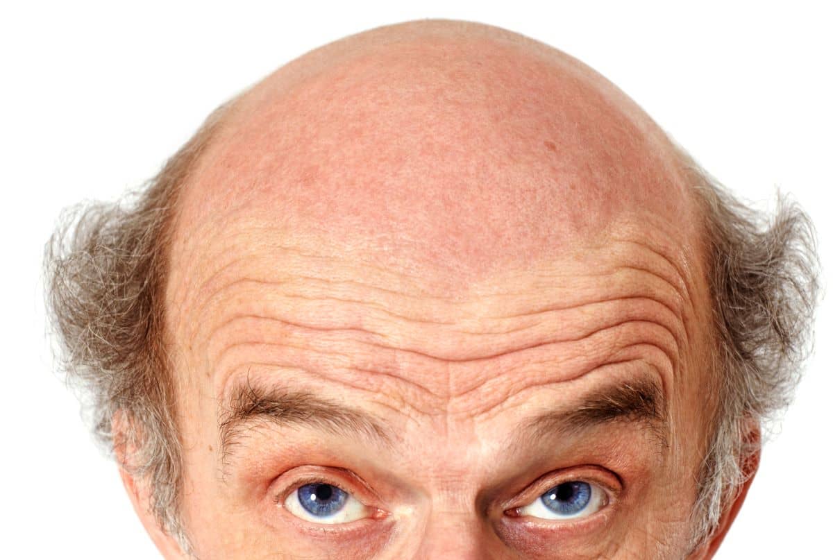 Älterer Mann mit Haarausfall