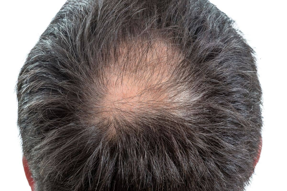 Mann mit kreisrundem Haarausfall 