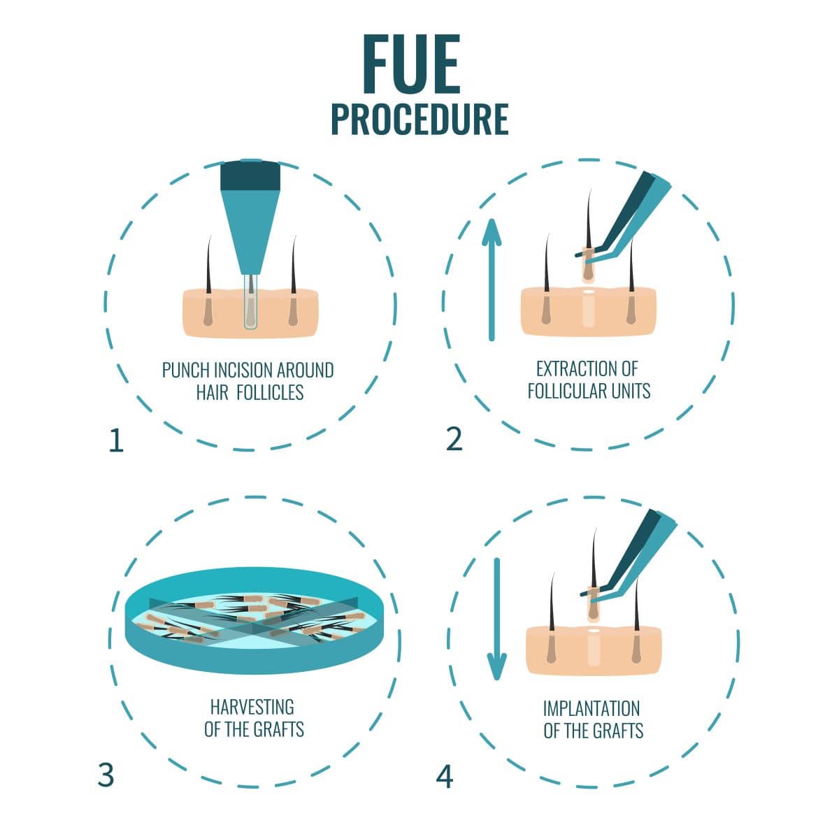 Haartransplantationsmethode - FUE-Methode 