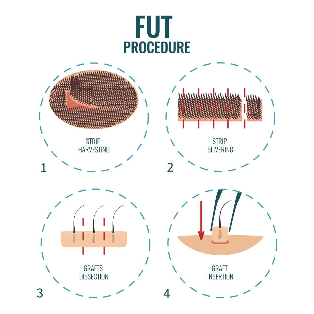 Haartransplantationsmethode - FUT-Methode