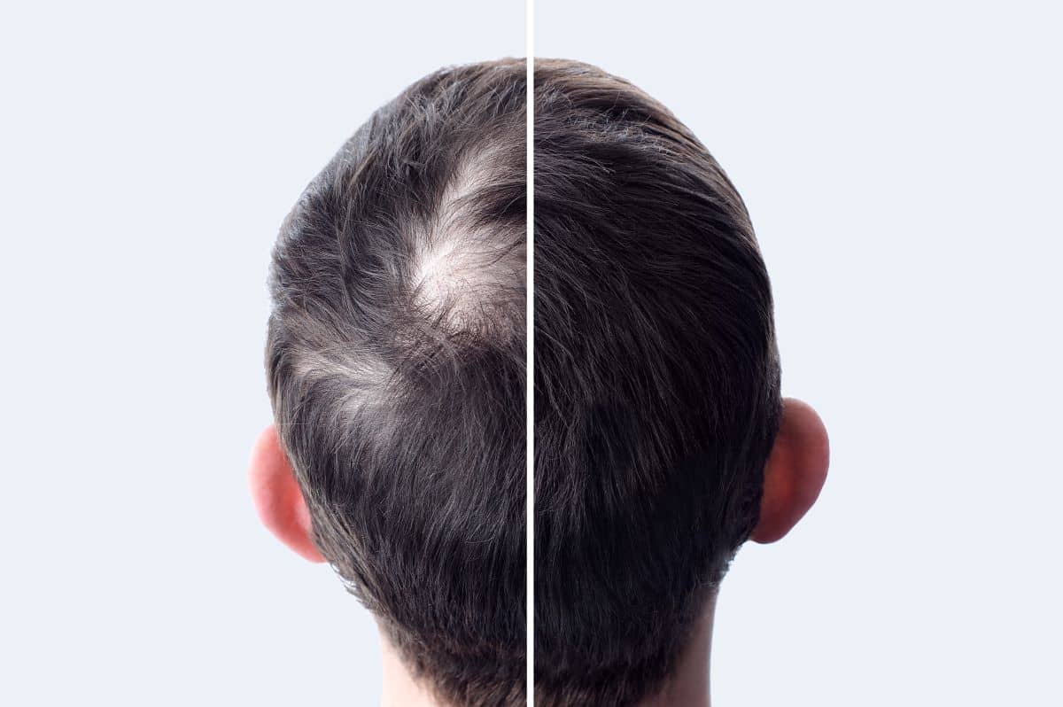 Haartransplantation-Mythen-Titelbild; Mann mit Haarausfall vorher-nachher Bild