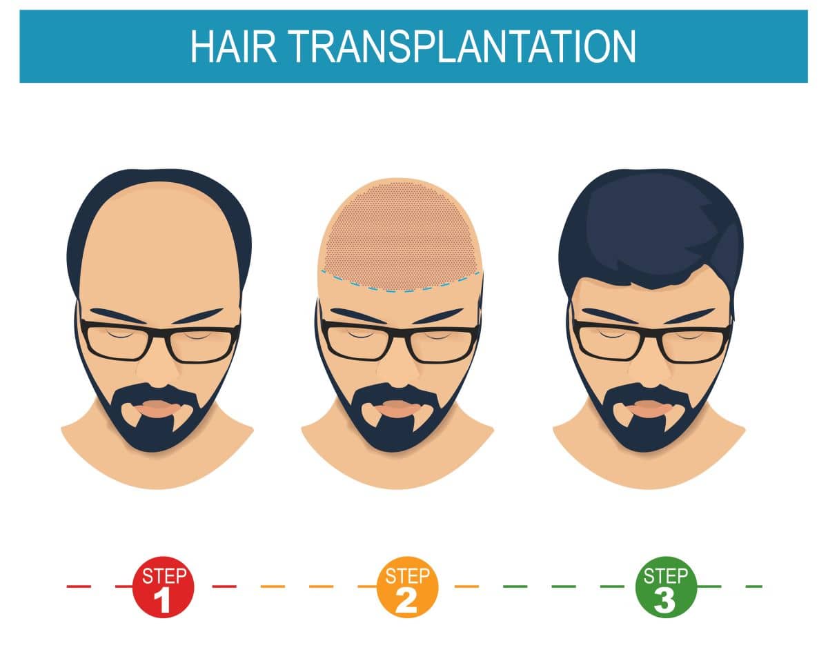 Haartransplantation Fehler - Prozess; Comicansicht von einer Haartransplantation 