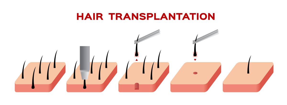 Haartransplantation-Selbstbewusstsein-Methode; Sketch vom Ablauf einer Haartransplantation